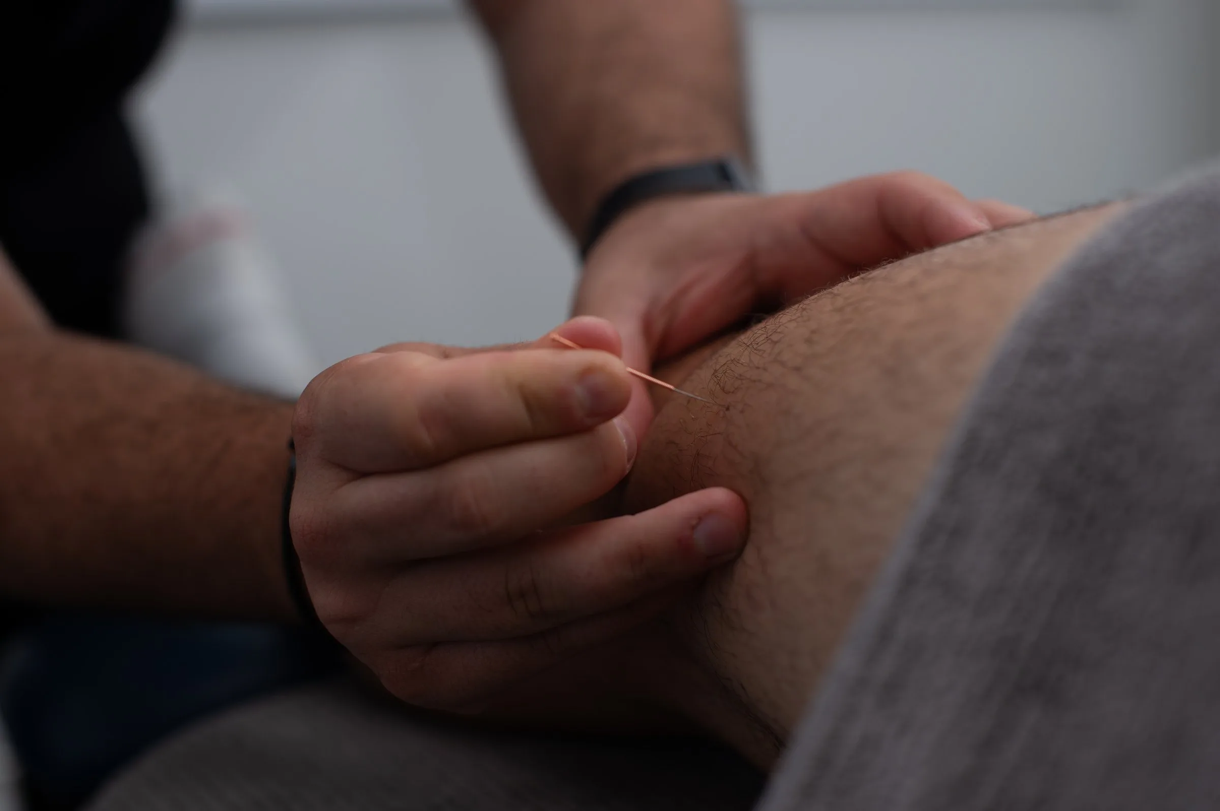Dry needling at Gladesville Healthcare